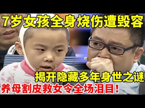 女孩全身烧伤遭毁容,揭开隐藏7年身世之谜!养母割皮救女令人泪目【王芳王为念访谈】