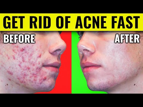 Say Goodbye to Acne: Dr. Berg's Proven Methods for Clearing Your Skin