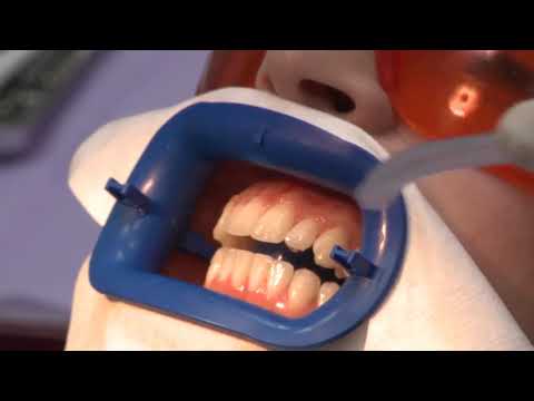 Philips Zoom 4 WhiteSpeed - отбеливающая лампа с LED-активатором отбеливания | Philips (Нидерланды)