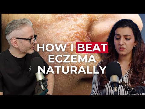 How I Beat Eczema by Ditching Steroid Creams and Healing My Gut