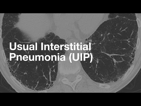 Usual Interstitial Pneumonia (UIP)