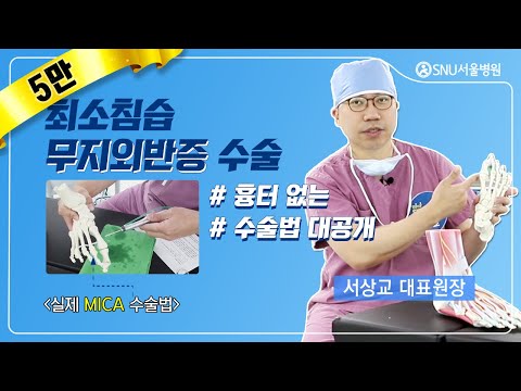 Surgical Technique Revealed! Minimally Invasive Hallux Valgus Surgery! #MICA #MinimallyInvasiveHa...