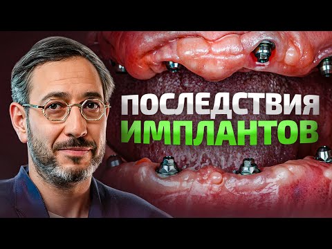 Имплантация зубов в 2025 – жалобы. Что НЕ так с имплантами?