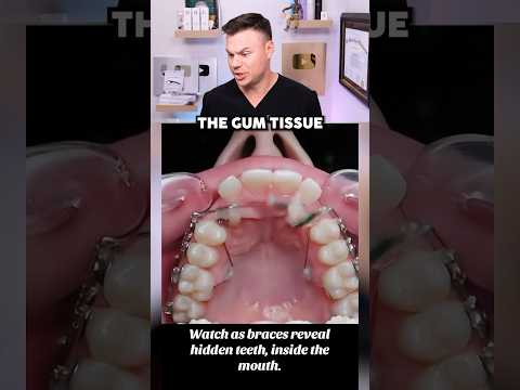 How Braces Can SHIFT Your Teeth! 😮🦷