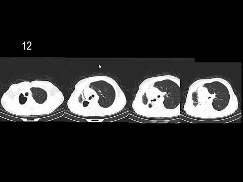 Thoracic Radiology Spotters | MD/DNB/DMRD Exam Preparation