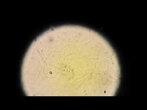 ЦИЛИНДРЫ гиалиновые в моче!