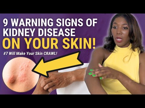 9 Silent Kidney Disease Symptoms Hiding On Your Skin - #7 Has My Skin Crawling