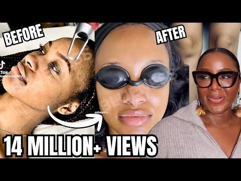 The VIRAL TikTok Hyperpigmentation Laser