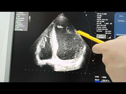Оценка сократимости миокарда визуально и по Симпсону