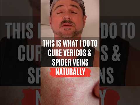 Natural Spider Vein Treatment That Actually Works!