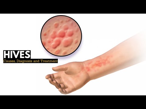 HIVES, Causes, Signs and Symptoms, Diagnosis and Treatment.