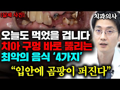 "가글도 소용없습니다" 잇몸 내려앉기 싫다면 이 '4가지' 음식 당장 끊으세요 (백승우 원장 1부)