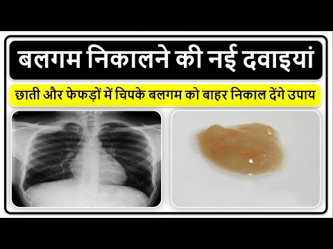 बलगम निकालने की नई दवाइयां, छाती और फेफड़ों में चिपके बलगम को बाहर निकाल देंगे उपाय, New Medicines