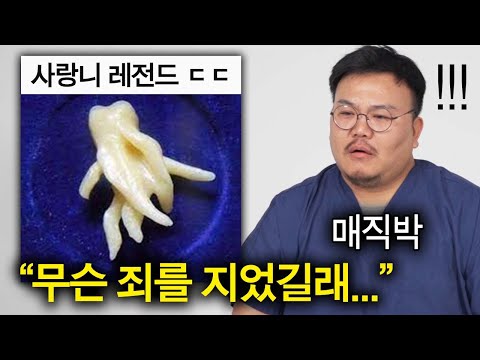 The legendary wisdom tooth that baffles even dentists (how did they get it removed?)