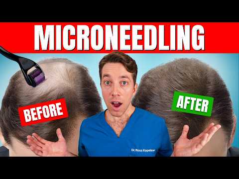 Does Microneedling Actually Regrow Hair? | Hair Surgeon's Advice