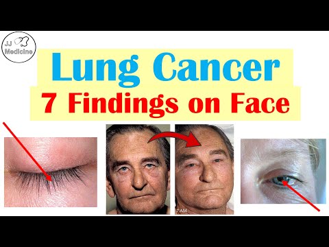 7 Findings on the Face That Can Reveal Lung Cancer Early
