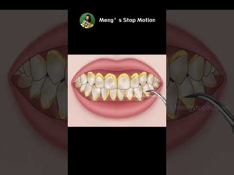 ASMR Animation | How to fix Bad Breath? 🦷Dental Cleaning to Remove Heavy Tartar!