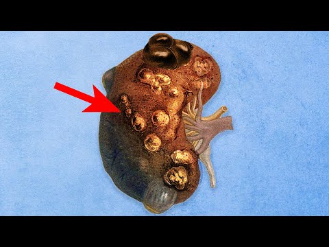 What Was Growing In His Kidneys Started Growing Everywhere