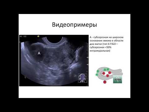 Классификация миомы матки FIGO