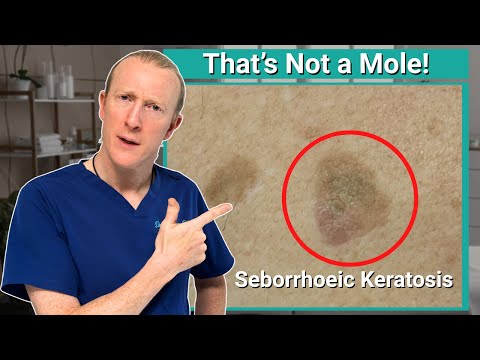 That's not a mole! Uncovering the Mystery of Seborrheic Keratosis