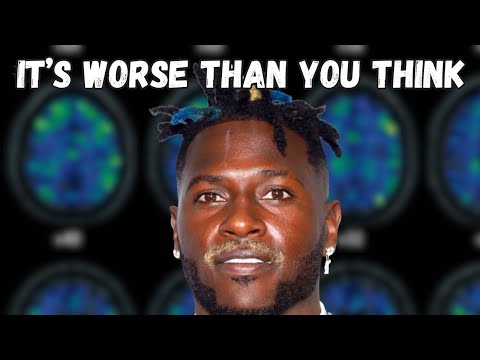 Why The NFL’s CTE Problem Is Worse Than You Think