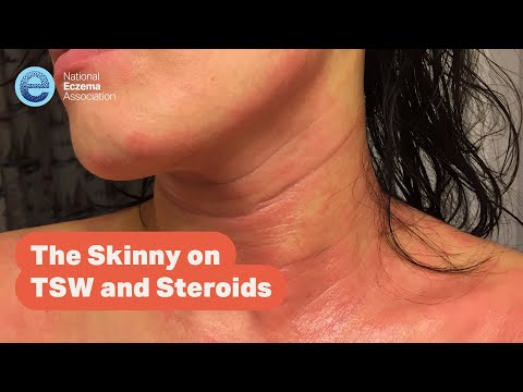 Webinar: The Skinny on TSW and Steroids