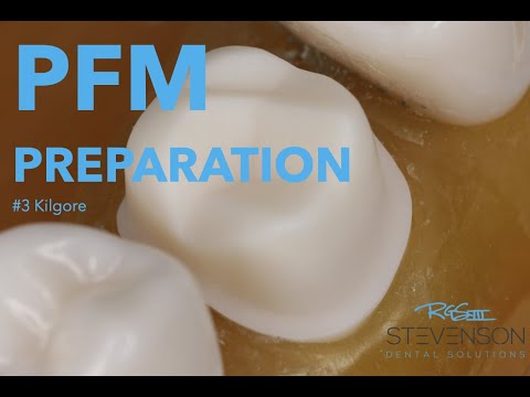 PFM Preparation on The Maxillary First Molar for #3 Kilgore | Stevenson Dental Solutions