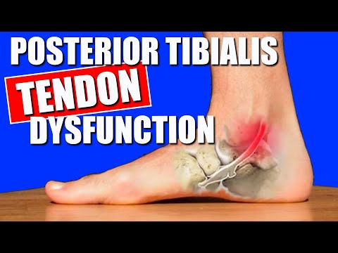 Posterior Tibialis Tendonitis: Symptoms, Causes & Treatment Tips for Pain Relief