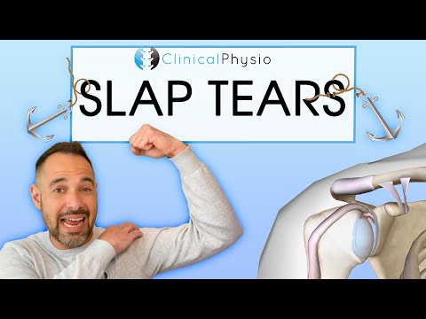 Superior Labral Anterior Posterior Tears | Everything you need to know about SLAP tears!