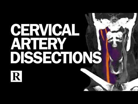 Cervical Arterial Dissections