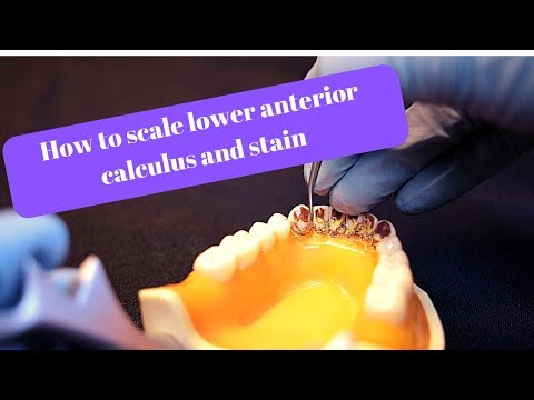How to scale mandibular anterior calculus and stain