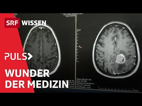 Unheilbar krank und doch genesen – Wenn Medizin «Wunder» schafft | Puls | SRF Wissen
