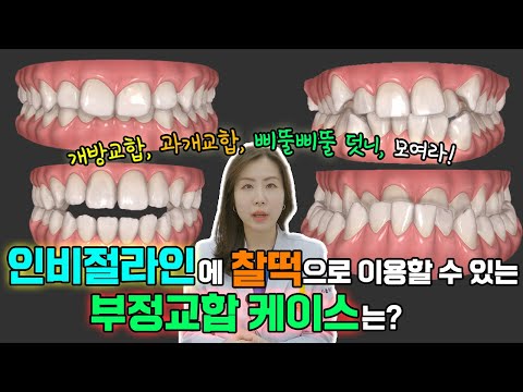 [인비절라인 특집] 인비절라인에 찰떡같이 딱 맞는 부정교합 케이스는 무엇일까요? 야, 너두 쉽고 편하게 교정할 수 있어!