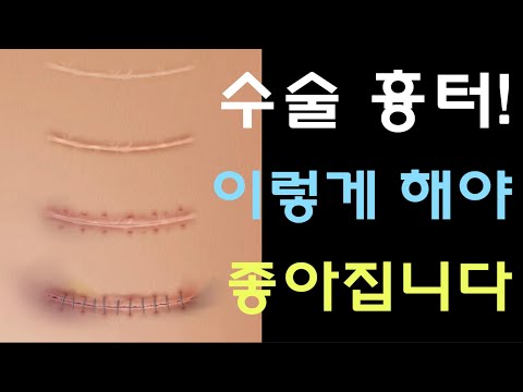 [닥터홍선생]#33.수술흉터! 이렇게 해야 좋아집니다. (수술흉터 안 생기도록 예방하는 방법& 흉터가 생겼다면 해야하는 치료법)