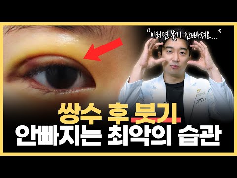 전문의가 알려주는 “쌍수 후 붓기 빨리 빼는 법”  쌍꺼풀 자연스럽게 자리잡고 싶다면 이렇게만 하세요