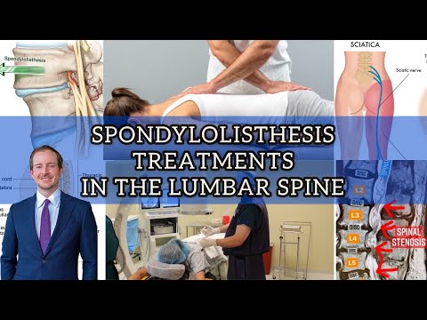 Spondylolisthesis Treatment Options in the Spine