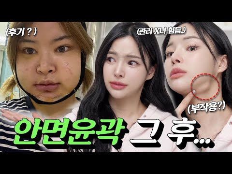 Do you regret getting facial contouring?;; Honest review..😢ft. Side effects/n 10 million won blown?💸