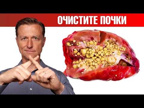 Очищение почек от оксалатов. Профилактика камней в почках ✅