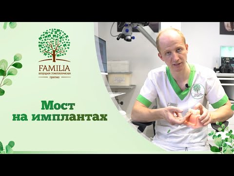 ➡ Мост на имплантах