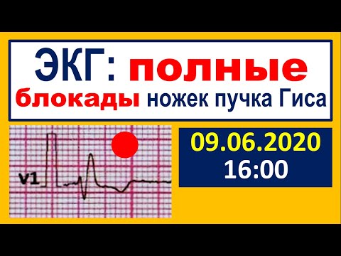 Важнейшие ЭКГ-синдромы: полные блокады ножек пучка Гиса