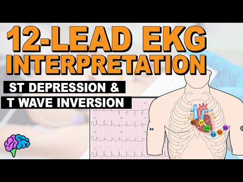 Myocardial Ischemia - ST Depression & T Wave Inversion - 12-lead EKG