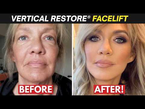 Look YEARS Younger! Vertical Restore® Facelift Explained