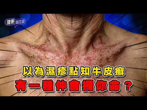 以為濕疹點知牛皮癬 有一種仲會攞你命？ ｜ 健康關注組 ｜ EP355 ｜ 銀屑病 ｜ 牛皮癬 ｜ 泛發性膿皰型銀屑病 ｜ 濕疹 ｜ 敖嘉年 ｜ 麥詩敏 ｜ HOY TV 77台