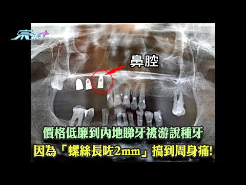 價格低廉到內地睇牙被游說種牙 因為「螺絲長咗2mm」搞到周身痛!
