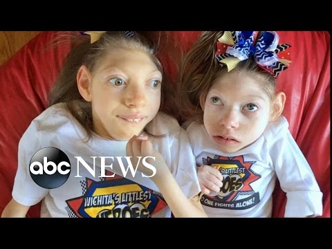 Kansas Parents of 2 Girls With Microcephaly Share Joys, Struggles of Family Life