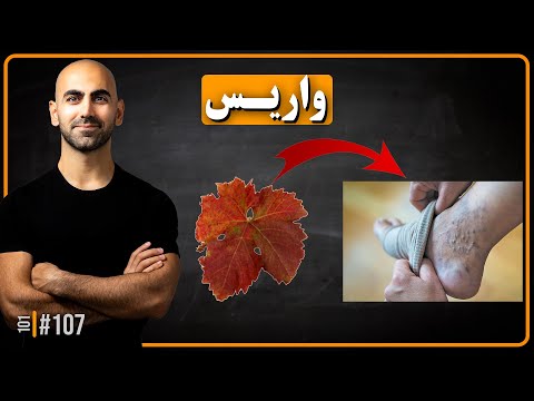 #107 - واریس | چرا درمان های رایج هیچ وقت جواب نمیده؟