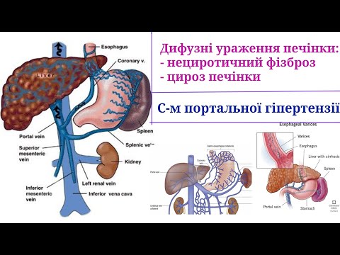 Дифузні ураження печінки: цироз, фіброз. Синдром портальної гіпертензії та його ускладнення -подкаст