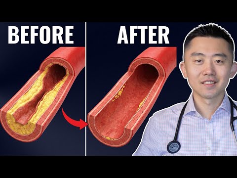 #1 Best Meal to UNCLOG Your Arteries (Backed by Science)
