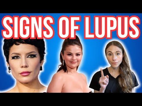 Signs Of Lupus Not To Miss | Butterfly Rash & MORE
