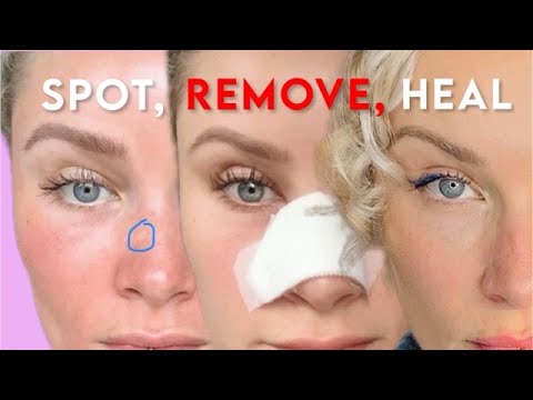 My Skin Cancer Story: signs, diagnosis, recovery, and tips, the real deal